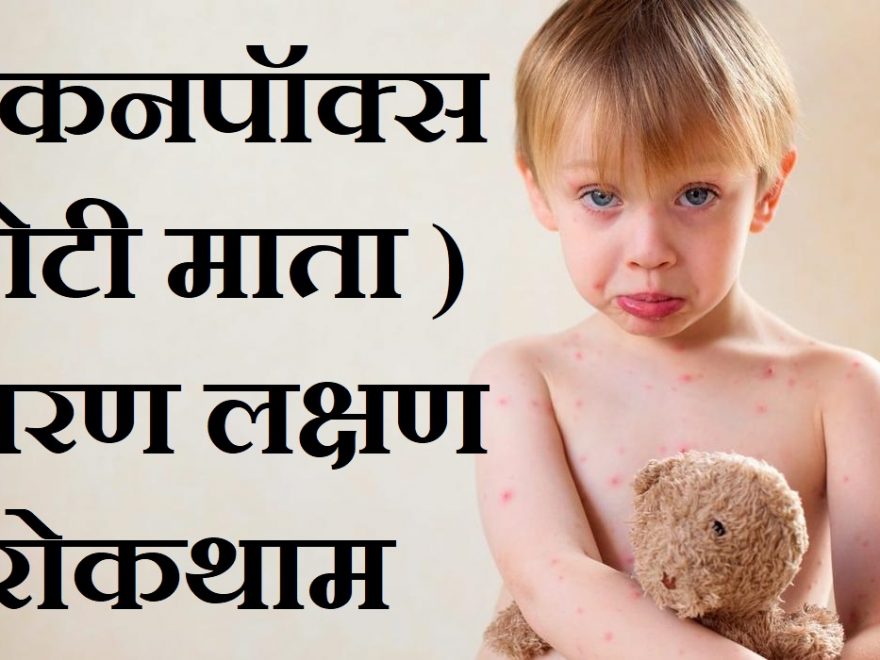 चिकनपॉक्स एवं स्मालपाक्स के कारण लक्षण व रोकथाम,chhoti mata kya hoti hai, Chickenpox Symtoms Effects Treatment In Hindi, nayichetana.com,chhoti mata ka ilaj