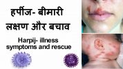 harpij thik karne ke upay,harpij se kaise bachav kare,हर्पीज़ के लक्षण समस्याएँ व बचाव के उपाय, Harpies Symptom Causes Treatment In Hindi,Herpes Symptoms Causes Treatment In Hindi