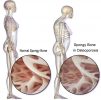 bones disease treatment in hindi