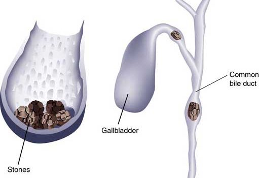 पित्ताशय की पथरी के प्रकार कारण लक्षण व उपचार, Gallbladder Stone Causes Precautions Treatment in Hindi,pathari pittashmari ke lakshan upchar