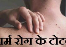 चर्म रोग के टोटके, skin diseases tricks in hindi,पतंजलि चर्म रोग मेडिसिन,चर्म रोग में परहेज,charm rog kya hai,skin problems solution in hindi