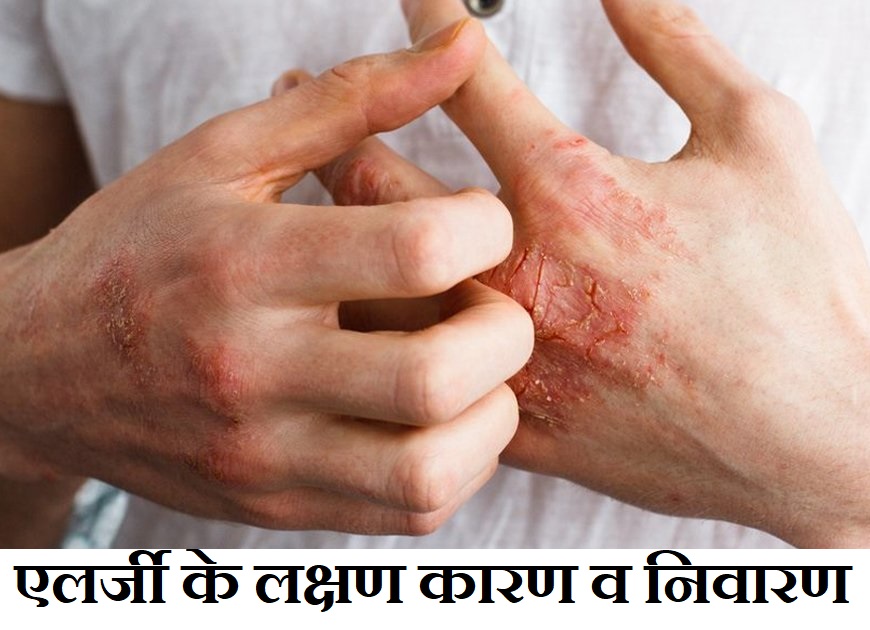 एलर्जी के लक्षण कारण व निवारण,Allergy Causes Symptoms Treatment In Hindi,Allergy ke nuksan,Allergy kaise hoti hai,Allergy ka matlab bataye