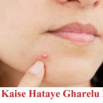 Pimple Kaise Hataye Gharelu Nuskhe,1 दिन में पिंपल हटाने का उपाय , pimple kaise remove kare, how to remove pimple in hindi, acne kaise hataye