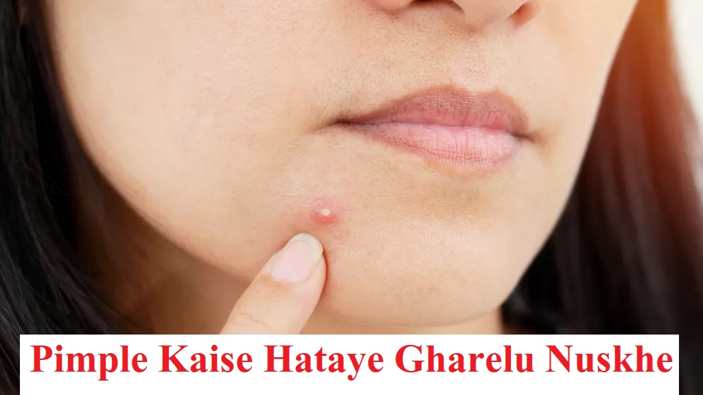 Pimple Kaise Hataye Gharelu Nuskhe 1 दिन में पिंपल हटाने का उपाय